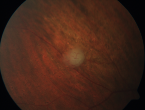 Retinal Capillary Hemangioma - Endophytic and Exophytic
46 year old female with normal vision - her father died of pancreatic cancer

