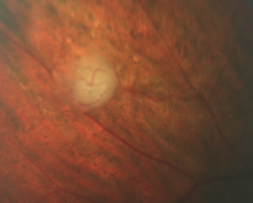 Retinal Capillary Hemangioma - Endophytic and Exophytic
46 year old female with normal vision - her father died of pancreatic cancer
