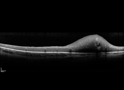 Retinal Capillary Hemangioma - Endophytic and Exophytic
46 year old female with normal vision - her father died of pancreatic cancer
