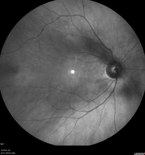 Retinal Capillary Hemangioma - Endophytic and Exophytic
46 year old female with normal vision - her father died of pancreatic cancer
