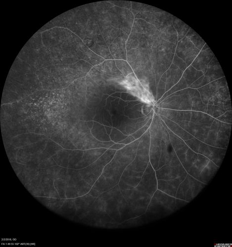 Retinal Capillary Hemangioma - Endophytic and Exophytic
46 year old female with normal vision - her father died of pancreatic cancer
