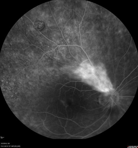 Retinal Capillary Hemangioma - Endophytic and Exophytic
46 year old female with normal vision - her father died of pancreatic cancer
