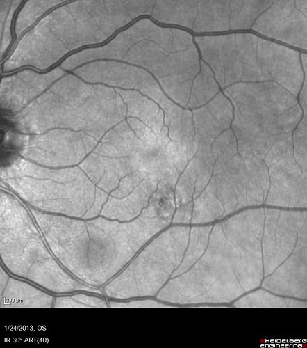 Chronic Central Serous Retinopathy - IR
