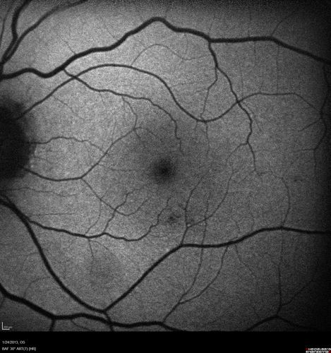 Chronic Central Serous Retinopathy - FAF
