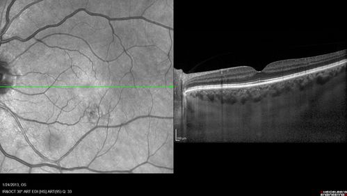 Chronic Central Serous Retinopathy - SD-OCT
