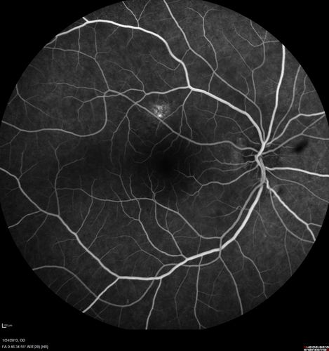 Chronic Central Serous Retinopathy - Fluorescein Angiogram
