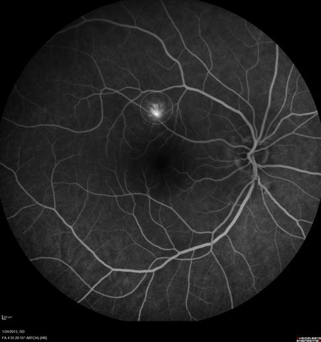 Chronic Central Serous Retinopathy - Fluorescein Angiogram
