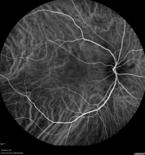 Chronic Central Serous Retinopathy - Indocyanine Green Angiogram 
