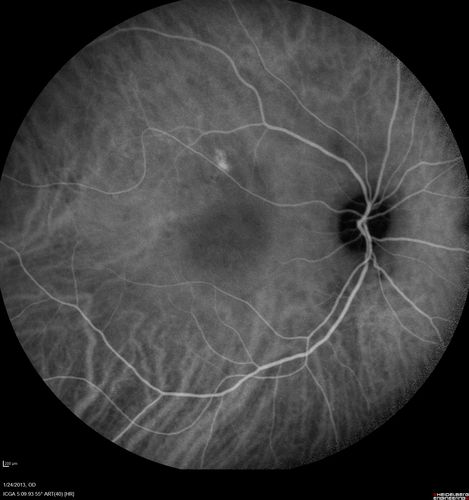 Chronic Central Serous Retinopathy - Indocyanine Green Angiogram 
