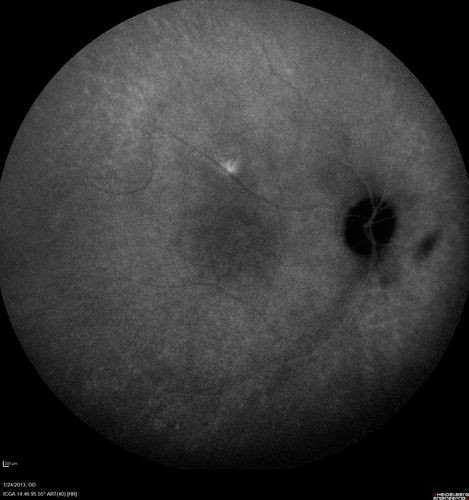 Chronic Central Serous Retinopathy - Indocyanine Green Angiogram 
