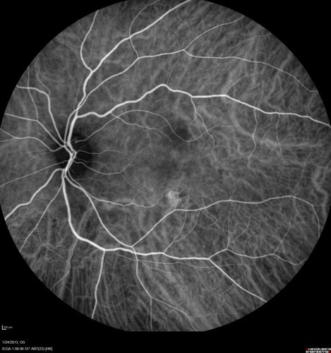 Chronic Central Serous Retinopathy - Indocyanine Green Angiogram 
Good Eye
