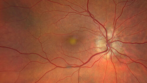 Dry Macular Degeneration with Pseudodrusen and vitelliform lesion
80 year old female with 20/50 vision in both eyes.  Mild blurring
