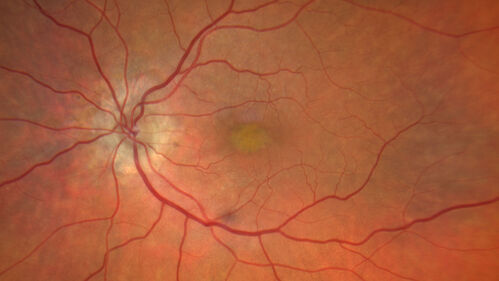 Dry Macular Degeneration with Pseudodrusen and vitelliform lesion
80 year old female with 20/50 vision in both eyes.  Mild blurring
