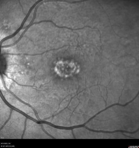 Dry Macular Degeneration with Pseudodrusen and vitelliform lesion
80 year old female with 20/50 vision in both eyes.  Mild blurring
