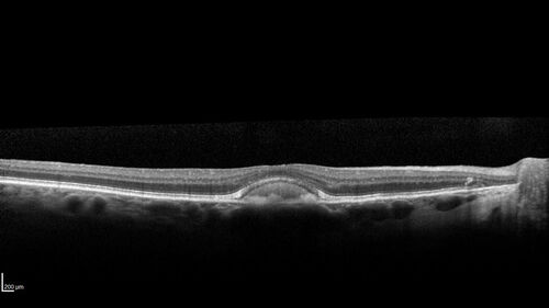 Dry Macular Degeneration with Pseudodrusen and vitelliform lesion
80 year old female with 20/50 vision in both eyes.  Mild blurring
