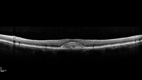 Dry Macular Degeneration with Pseudodrusen and vitelliform lesion
80 year old female with 20/50 vision in both eyes.  Mild blurring
