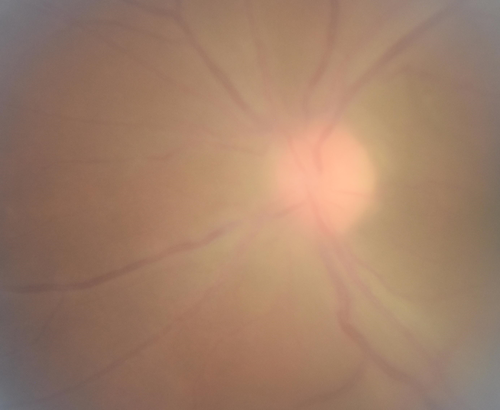 Toxoplasmosis - Recurrent - Moderate Vitritis
32 year old woman with 20/80 vision and moderately painful red eye in the left eye only.  The left eye had some redness about 10 years ago.  She is a native of Sierra Leone
