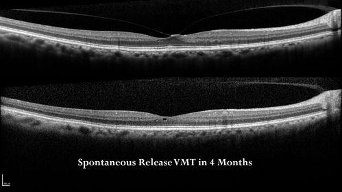 Vitreomacular Traction - Spontaneous Aborted - Both Eyes - 4 months
