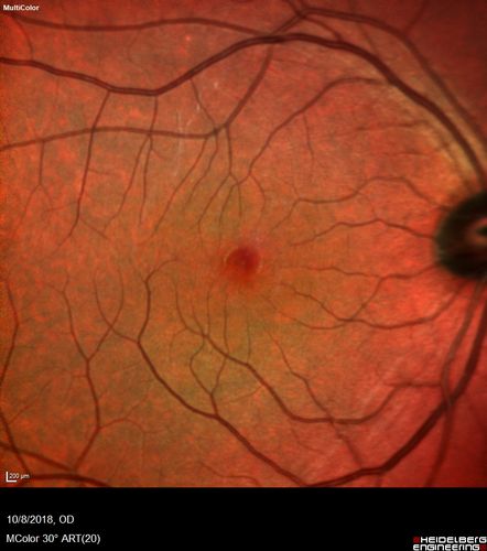 Vitreomacular traction OU - Aborted in 3 months
62 year old female with blurred vision in both eyes for 2 months intermittently.  She was referred for macular edema.
A 20/32 OD, 20/25 OS
OCT showed VMT in one eye and edema in the other
3 months later in the last 2 OCT scans 
VA 20/20 OD, 20/16 OS and VMT had released.
