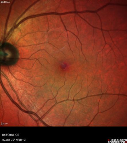 Vitreomacular traction OU - Aborted in 3 months
62 year old female with blurred vision in both eyes for 2 months intermittently.  She was referred for macular edema.
A 20/32 OD, 20/25 OS
OCT showed VMT in one eye and edema in the other
3 months later in the last 2 OCT scans 
VA 20/20 OD, 20/16 OS and VMT had released.
