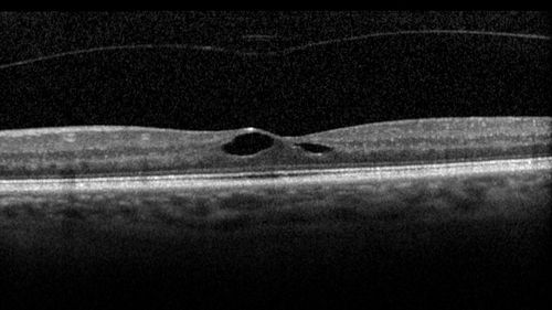 Vitreomacular traction OU - Aborted in 3 months - left eye initial isit
62 year old female with blurred vision in both eyes for 2 months intermittently.  She was referred for macular edema.
A 20/32 OD, 20/25 OS
OCT showed VMT in one eye and edema in the other
3 months later in the last 2 OCT scans 
VA 20/20 OD, 20/16 OS and VMT had released.
