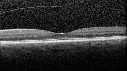 Vitreomacular traction OU - Aborted in 3 months - left eye 3 months f-u
62 year old female with blurred vision in both eyes for 2 months intermittently.  She was referred for macular edema.
A 20/32 OD, 20/25 OS
OCT showed VMT in one eye and edema in the other
3 months later in the last 2 OCT scans 
VA 20/20 OD, 20/16 OS and VMT had released.
