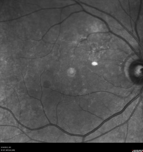 Vitreomacular traction - recent vision loss Right Eye - initially worse after Jetrea
