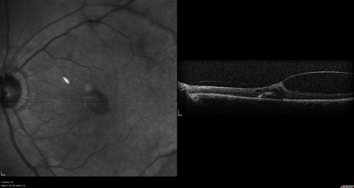 Vitreomacular traction - recent vision loss - preop SD OCT
