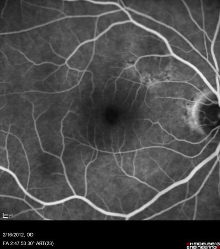Vitreomacular traction - recent vision loss left eye - FA
