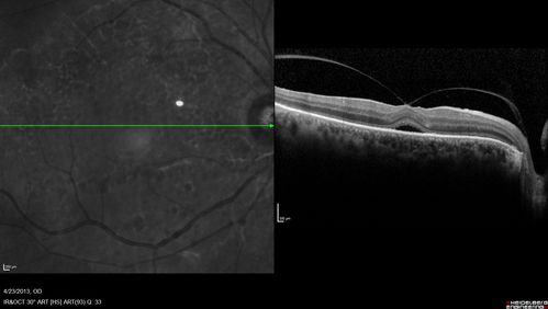 Vitreomacular traction - recent vision loss Right Eye 

