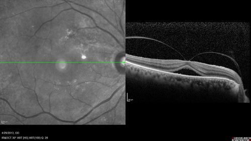 Vitreomacular traction - recent vision loss Right Eye - initially worse after Jetrea
