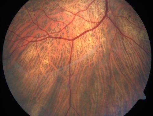Vitreomacular traction with traction over retinal vessels in non-diabetic - Fluorescein leakage in areas of traction - Progressing vision loss left eye
80-year-old woman had vitrectomy surgery done in the right eye in 2007. Vision has been poor since despite a good anatomical result. Recently her vision in the left eye has been declining.  The vision has declined in the left eye. Vision OD is 20/160, OS is 20/80
