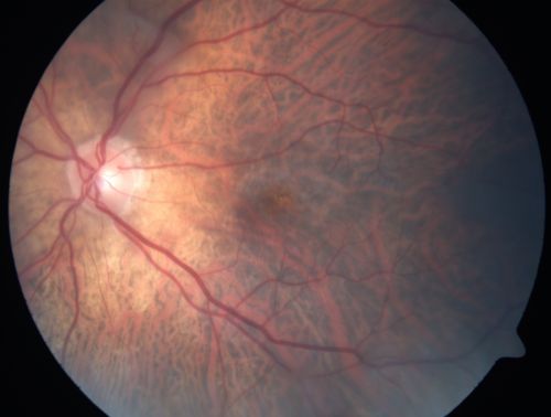 Vitreomacular traction with traction over retinal vessels in non-diabetic - Fluorescein leakage in areas of traction - Progressing vision loss left eye
80-year-old woman had vitrectomy surgery done in the right eye in 2007. Vision has been poor since despite a good anatomical result. Recently her vision in the left eye has been declining.  The vision has declined in the left eye. Vision OD is 20/160, OS is 20/80
