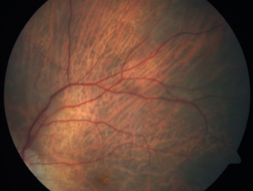 Vitreomacular traction with traction over retinal vessels in non-diabetic - Fluorescein leakage in areas of traction - Progressing vision loss left eye
80-year-old woman had vitrectomy surgery done in the right eye in 2007. Vision has been poor since despite a good anatomical result. Recently her vision in the left eye has been declining.  The vision has declined in the left eye. Vision OD is 20/160, OS is 20/80
