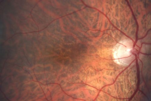 Vitreomacular traction with traction over retinal vessels in non-diabetic - Fluorescein leakage in areas of traction - Progressing vision loss left eye
80-year-old woman had vitrectomy surgery done in the right eye in 2007. Vision has been poor since despite a good anatomical result. Recently her vision in the left eye has been declining.  The vision has declined in the left eye. Vision OD is 20/160, OS is 20/80
