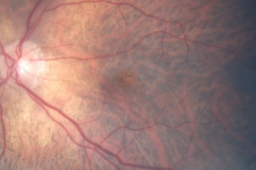 Vitreomacular traction with traction over retinal vessels in non-diabetic - Fluorescein leakage in areas of traction - Progressing vision loss left eye
80-year-old woman had vitrectomy surgery done in the right eye in 2007. Vision has been poor since despite a good anatomical result. Recently her vision in the left eye has been declining.  The vision has declined in the left eye. Vision OD is 20/160, OS is 20/80

