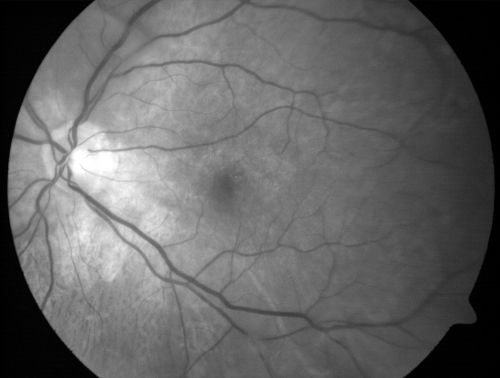 Vitreomacular traction with traction over retinal vessels in non-diabetic - Fluorescein leakage in areas of traction - Progressing vision loss left eye
80-year-old woman had vitrectomy surgery done in the right eye in 2007. Vision has been poor since despite a good anatomical result. Recently her vision in the left eye has been declining.  The vision has declined in the left eye. Vision OD is 20/160, OS is 20/80
