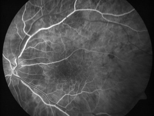 Vitreomacular traction with traction over retinal vessels in non-diabetic - Fluorescein leakage in areas of traction - Progressing vision loss left eye
80-year-old woman had vitrectomy surgery done in the right eye in 2007. Vision has been poor since despite a good anatomical result. Recently her vision in the left eye has been declining.  The vision has declined in the left eye. Vision OD is 20/160, OS is 20/80
