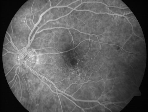 Vitreomacular traction with traction over retinal vessels in non-diabetic - Fluorescein leakage in areas of traction - Progressing vision loss left eye
80-year-old woman had vitrectomy surgery done in the right eye in 2007. Vision has been poor since despite a good anatomical result. Recently her vision in the left eye has been declining.  The vision has declined in the left eye. Vision OD is 20/160, OS is 20/80
