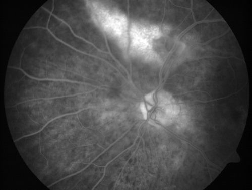Vitreomacular traction with traction over retinal vessels in non-diabetic - Fluorescein leakage in areas of traction - Progressing vision loss left eye
80-year-old woman had vitrectomy surgery done in the right eye in 2007. Vision has been poor since despite a good anatomical result. Recently her vision in the left eye has been declining.  The vision has declined in the left eye. Vision OD is 20/160, OS is 20/80
