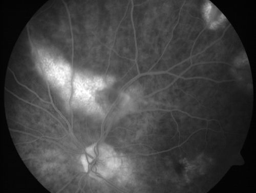 Vitreomacular traction with traction over retinal vessels in non-diabetic - Fluorescein leakage in areas of traction - Progressing vision loss left eye
80-year-old woman had vitrectomy surgery done in the right eye in 2007. Vision has been poor since despite a good anatomical result. Recently her vision in the left eye has been declining.  The vision has declined in the left eye. Vision OD is 20/160, OS is 20/80
