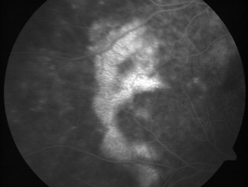 Vitreomacular traction with traction over retinal vessels in non-diabetic - Fluorescein leakage in areas of traction - Progressing vision loss left eye
80-year-old woman had vitrectomy surgery done in the right eye in 2007. Vision has been poor since despite a good anatomical result. Recently her vision in the left eye has been declining.  The vision has declined in the left eye. Vision OD is 20/160, OS is 20/80
