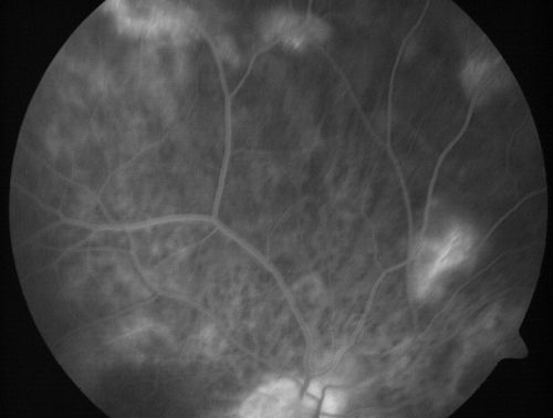 Vitreomacular traction with traction over retinal vessels in non-diabetic - Fluorescein leakage in areas of traction - Progressing vision loss left eye
80-year-old woman had vitrectomy surgery done in the right eye in 2007. Vision has been poor since despite a good anatomical result. Recently her vision in the left eye has been declining.  The vision has declined in the left eye. Vision OD is 20/160, OS is 20/80
