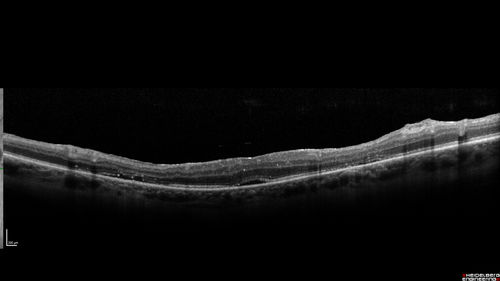Hyperpigmented Vasoproliferative Tumor on Buckle with New Serous Retinal Detachment 20 years post RD Repair
67 year old female RD repair OU 1999 then severe (20/400) macular pucker OD removed 3 months later (twin sister also had bilateral RDâ€™s with PVR).  Then dislocated IOL surgery right eye 9/2012.  New vision loss in the right eye with serous retinal detachment.  Argon laser to dark tumor led to resolution of subretinal fluid within a month.
