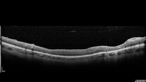 Hyperpigmented Vasoproliferative Tumor on Buckle with New Serous Retinal Detachment 20 years post RD Repair
67 year old female RD repair OU 1999 then severe (20/400) macular pucker OD removed 3 months later (twin sister also had bilateral RDâ€™s with PVR).  Then dislocated IOL surgery right eye 9/2012.  New vision loss in the right eye with serous retinal detachment.  Argon laser to dark tumor led to resolution of subretinal fluid within a month.
