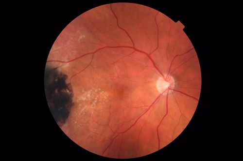 Hyperpigmented Vasoproliferative Tumor on Buckle with New Serous Retinal Detachment 20 years post RD Repair
67 year old female RD repair OU 1999 then severe (20/400) macular pucker OD removed 3 months later (twin sister also had bilateral RDâ€™s with PVR).  Then dislocated IOL surgery right eye 9/2012.  New vision loss in the right eye with serous retinal detachment.  Argon laser to dark tumor led to resolution of subretinal fluid within a month.
