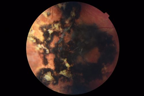 Hyperpigmented Vasoproliferative Tumor on Buckle with New Serous Retinal Detachment 20 years post RD Repair
67 year old female RD repair OU 1999 then severe (20/400) macular pucker OD removed 3 months later (twin sister also had bilateral RDâ€™s with PVR).  Then dislocated IOL surgery right eye 9/2012.  New vision loss in the right eye with serous retinal detachment.  Argon laser to dark tumor led to resolution of subretinal fluid within a month.
