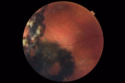 Hyperpigmented Vasoproliferative Tumor on Buckle with New Serous Retinal Detachment 20 years post RD Repair
67 year old female RD repair OU 1999 then severe (20/400) macular pucker OD removed 3 months later (twin sister also had bilateral RDâ€™s with PVR).  Then dislocated IOL surgery right eye 9/2012.  New vision loss in the right eye with serous retinal detachment.  Argon laser to dark tumor led to resolution of subretinal fluid within a month.
