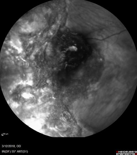 Hyperpigmented Vasoproliferative Tumor on Buckle with New Serous Retinal Detachment 20 years post RD Repair
67 year old female RD repair OU 1999 then severe (20/400) macular pucker OD removed 3 months later (twin sister also had bilateral RDâ€™s with PVR).  Then dislocated IOL surgery right eye 9/2012.  New vision loss in the right eye with serous retinal detachment.  Argon laser to dark tumor led to resolution of subretinal fluid within a month.
