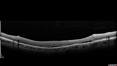 Hyperpigmented Vasoproliferative Tumor on Buckle with New Serous Retinal Detachment 20 years post RD Repair
67 year old female RD repair OU 1999 then severe (20/400) macular pucker OD removed 3 months later (twin sister also had bilateral RDâ€™s with PVR).  Then dislocated IOL surgery right eye 9/2012.  New vision loss in the right eye with serous retinal detachment.  Argon laser to dark tumor led to resolution of subretinal fluid within a month.
